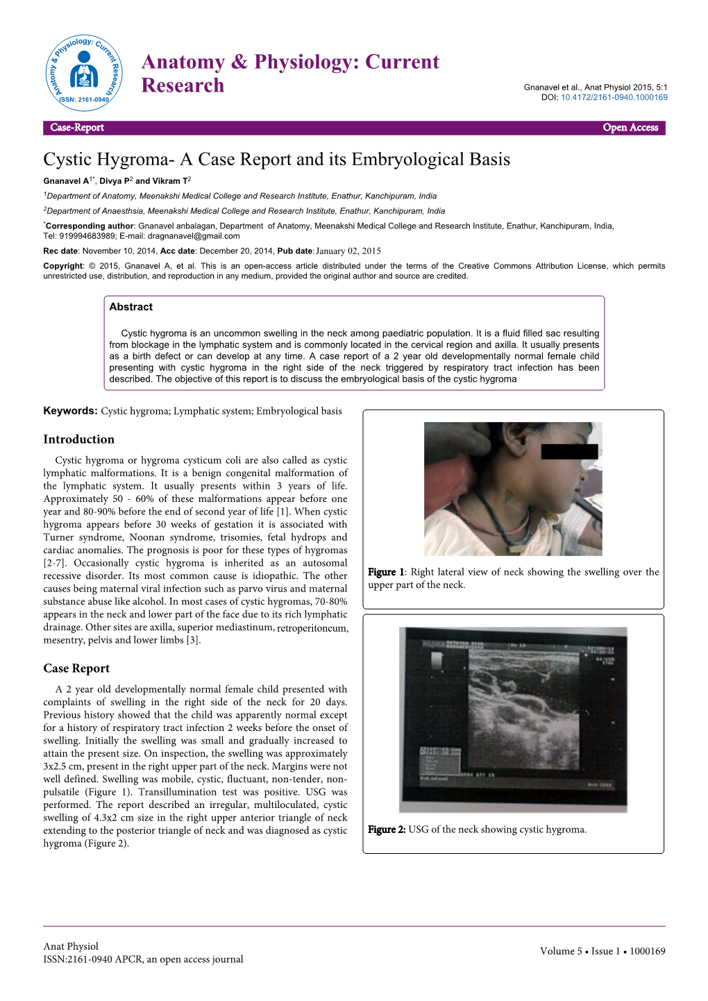 Cystic Hygroma- a Case Report and Its Embryological Basis