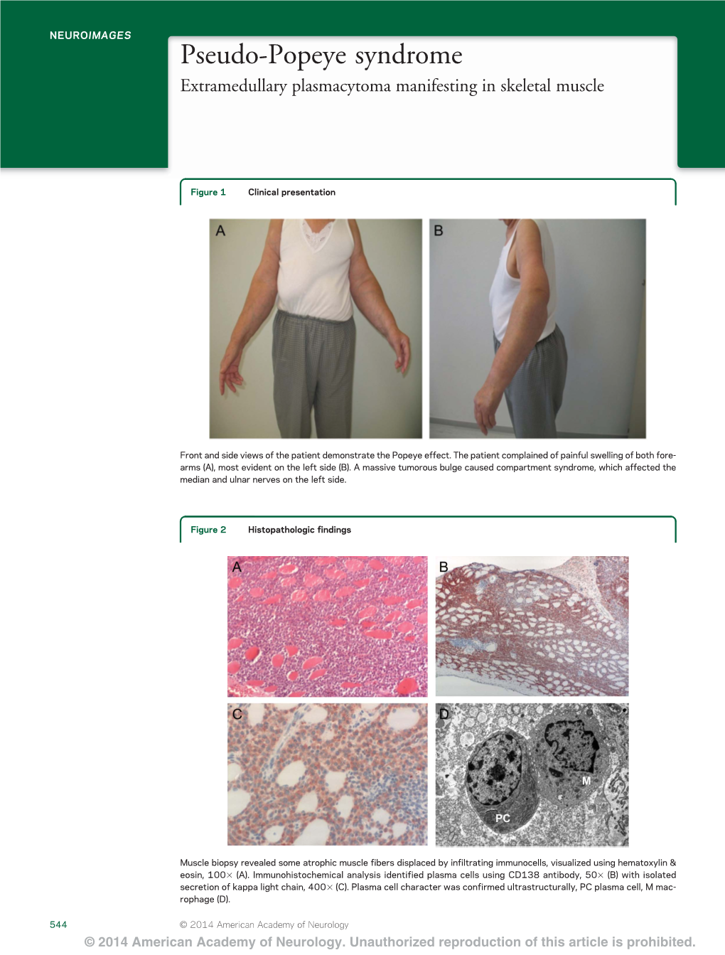 Pseudo-Popeye Syndrome Extramedullary Plasmacytoma Manifesting in Skeletal Muscle