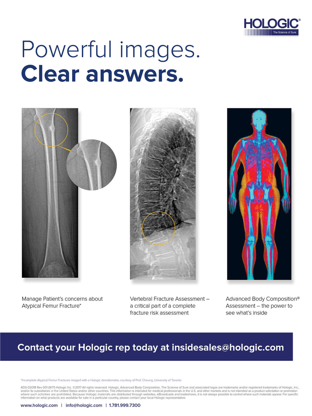 Diagnosis and Management of Pagetls Disease of Bone in Adults