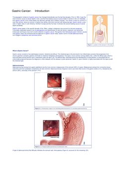 Gastric Cancer: Introduction