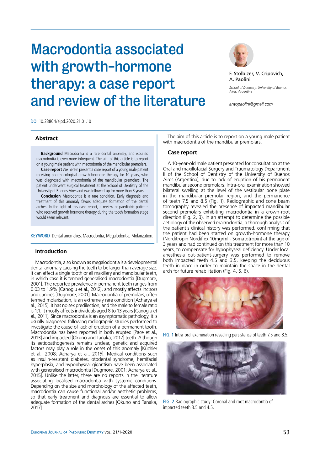 Macrodontia Associated with Growth-Hormone Therapy