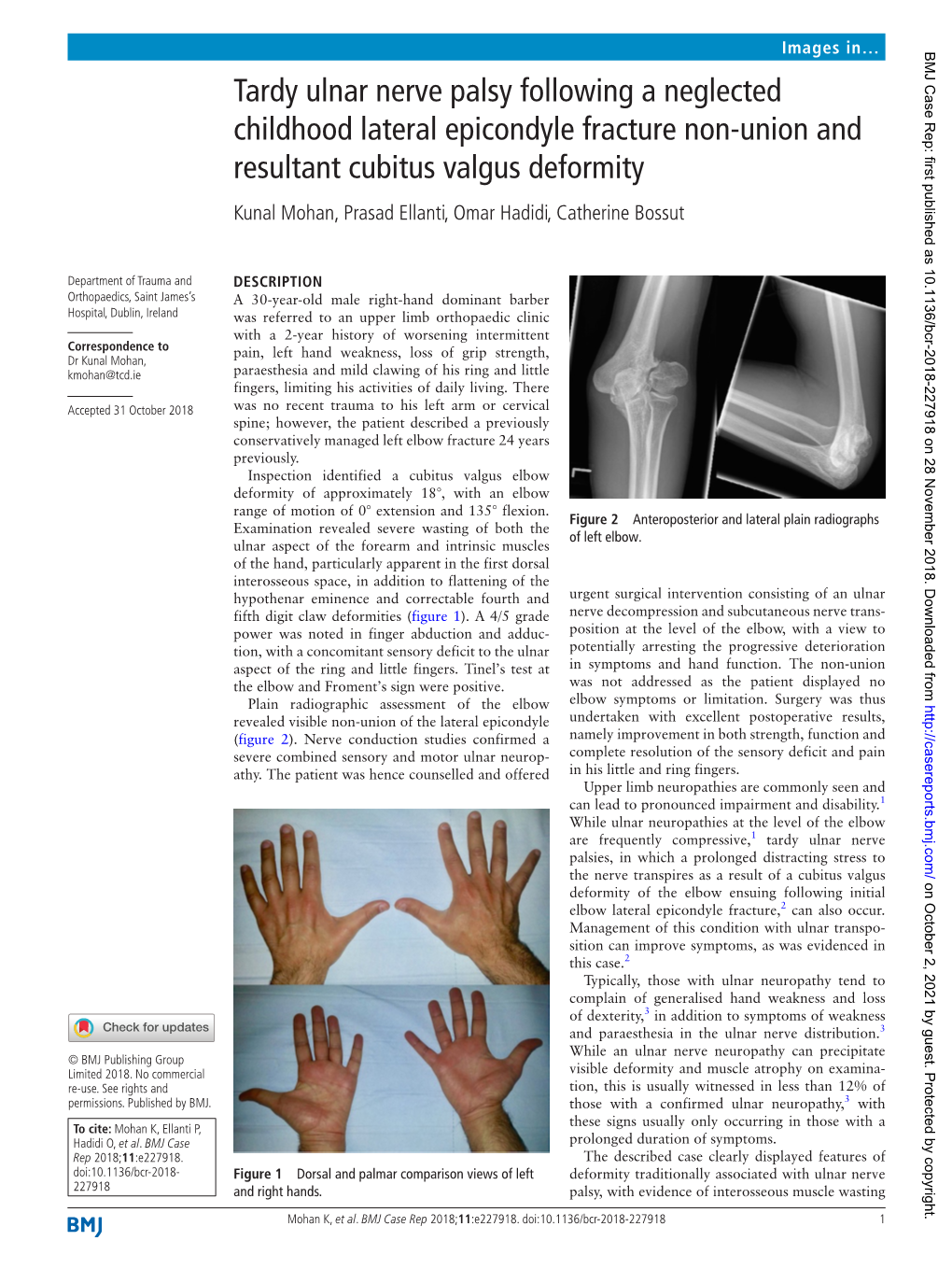 tardy-ulnar-nerve-palsy-following-a-neglected-childhood-lateral-docslib