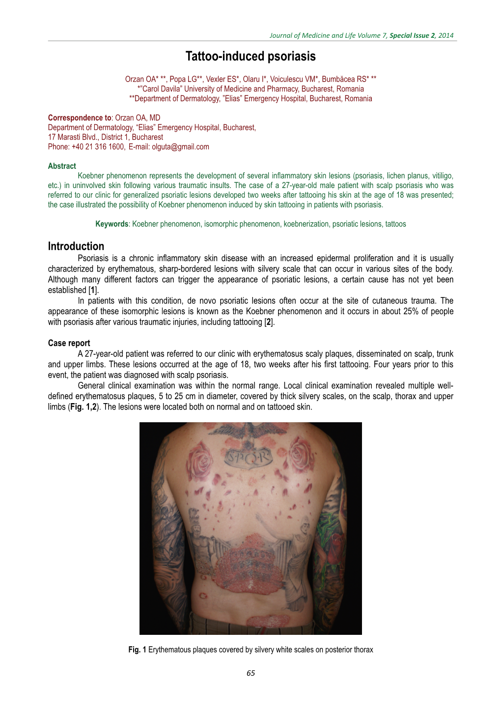 Tattoo-Induced Psoriasis