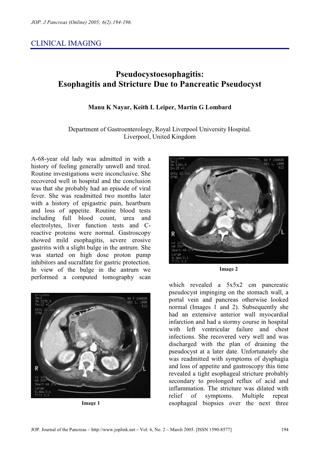 Esophagitis and Stricture Due to Pancreatic Pseudocyst