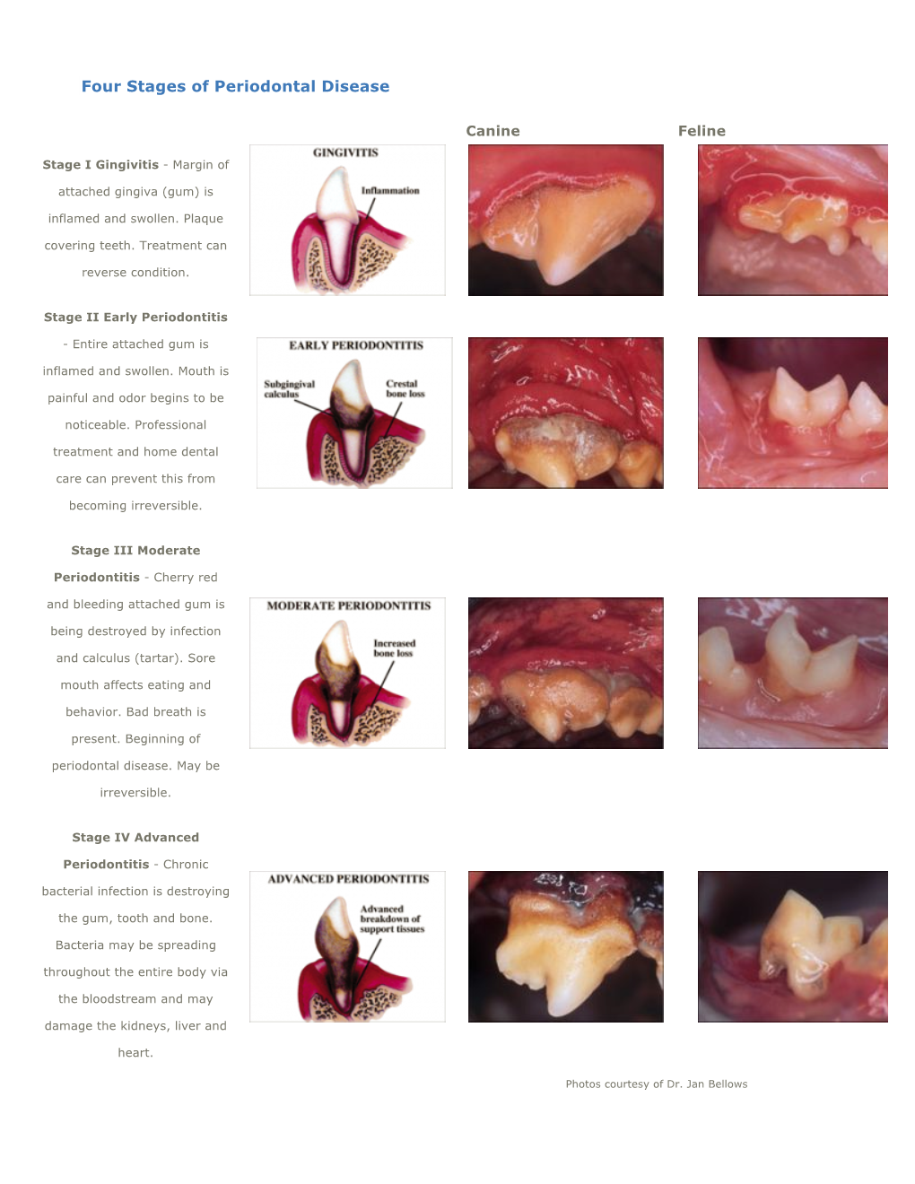 Four Stages of Periodontal Disease