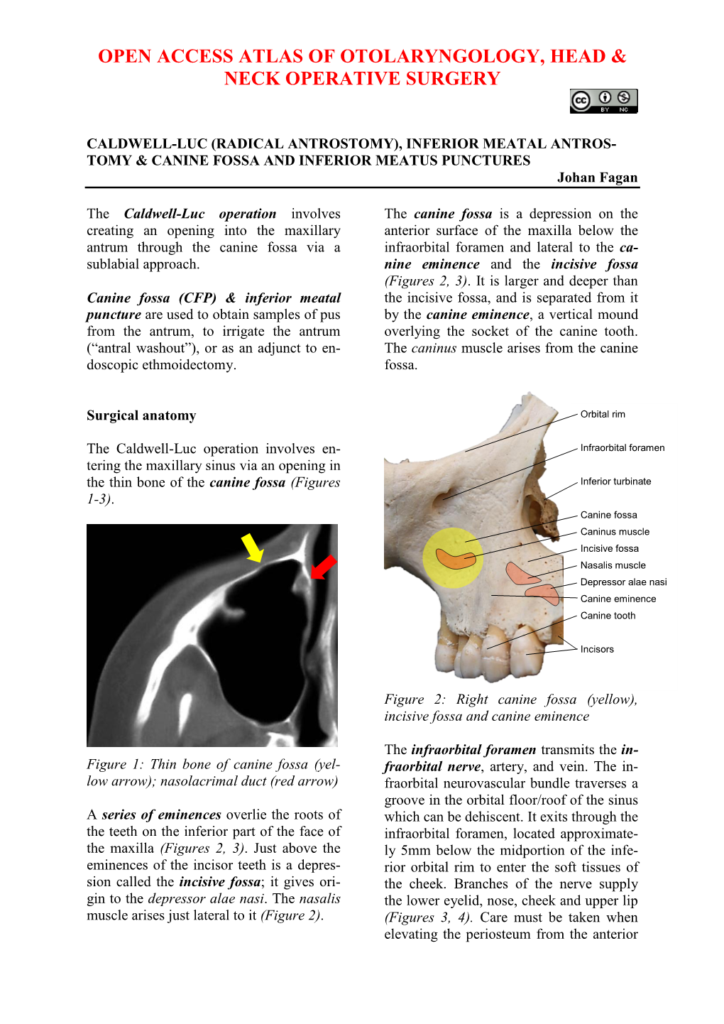 Procedure, Inferior and Canine Fossa Puncture, Inferior Meatal Antrostomy