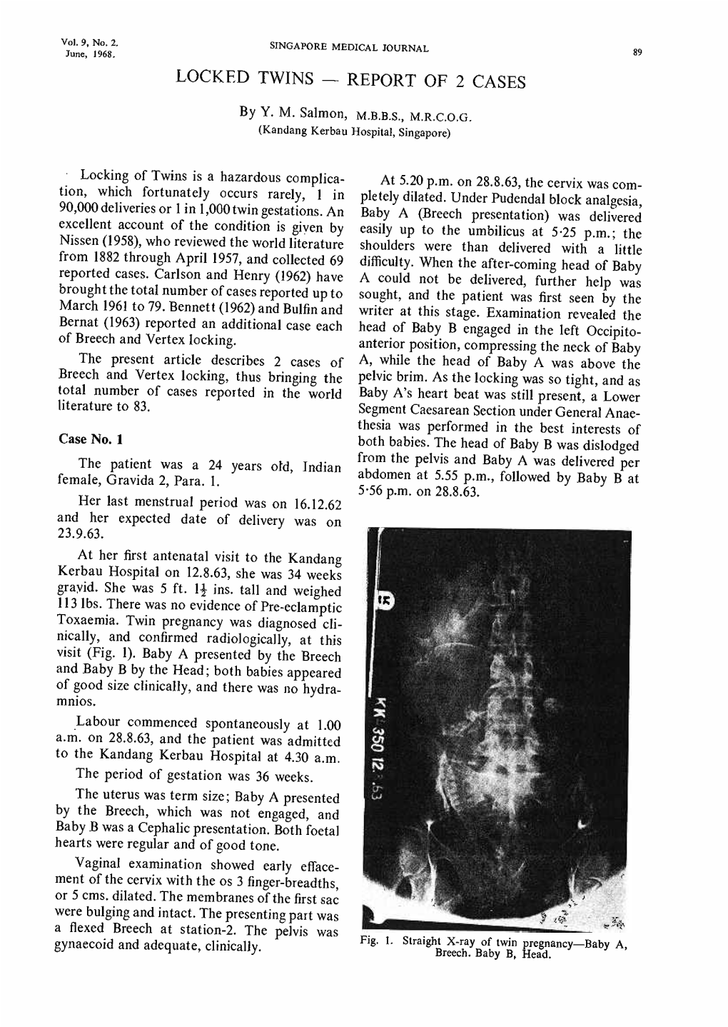 Locked Twins - Report of 2 Cases