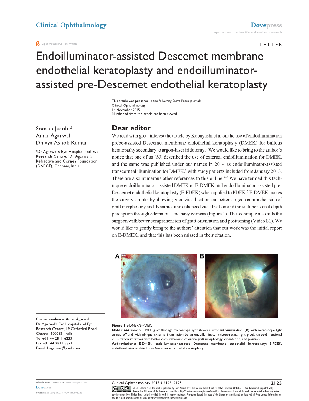 Assisted Pre-Descemet Endothelial Keratoplasty