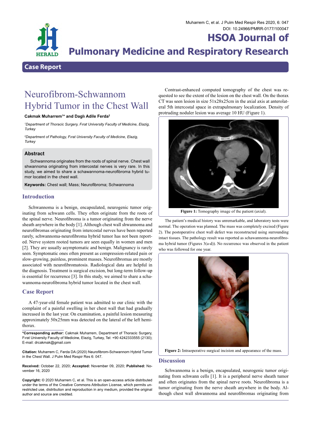 Neurofibrom-Schwannom Hybrid Tumor in the Chest Wall