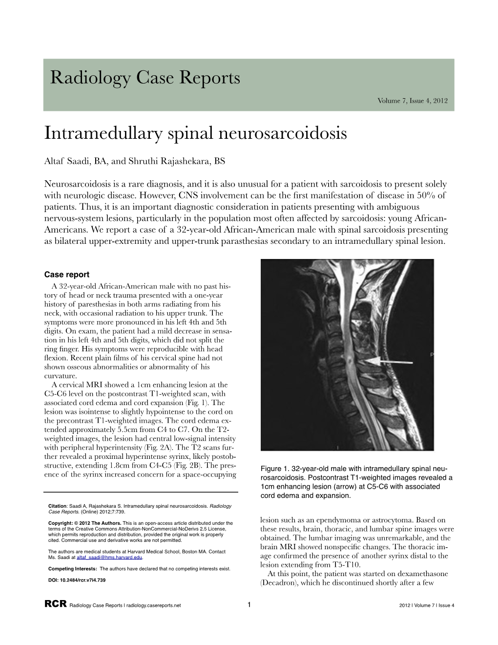 Intramedullary Spinal Neurosarcoidosis