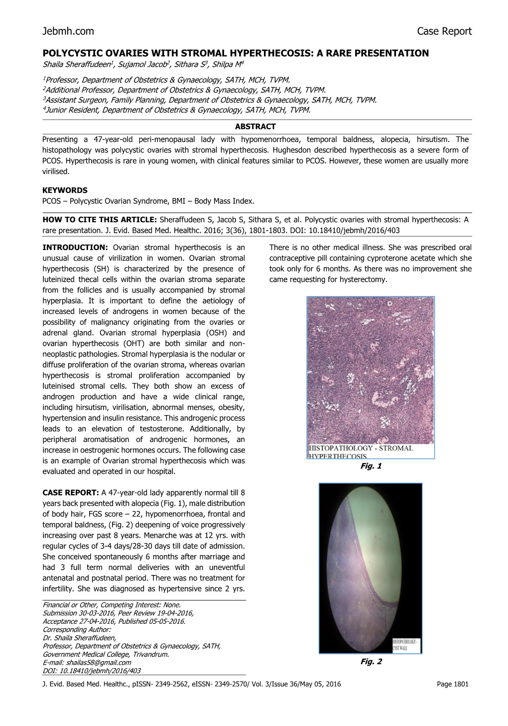 POLYCYSTIC OVARIES with STROMAL HYPERTHECOSIS: a RARE PRESENTATION Shaila Sheraffudeen1, Sujamol Jacob2, Sithara S3, Shilpa M4