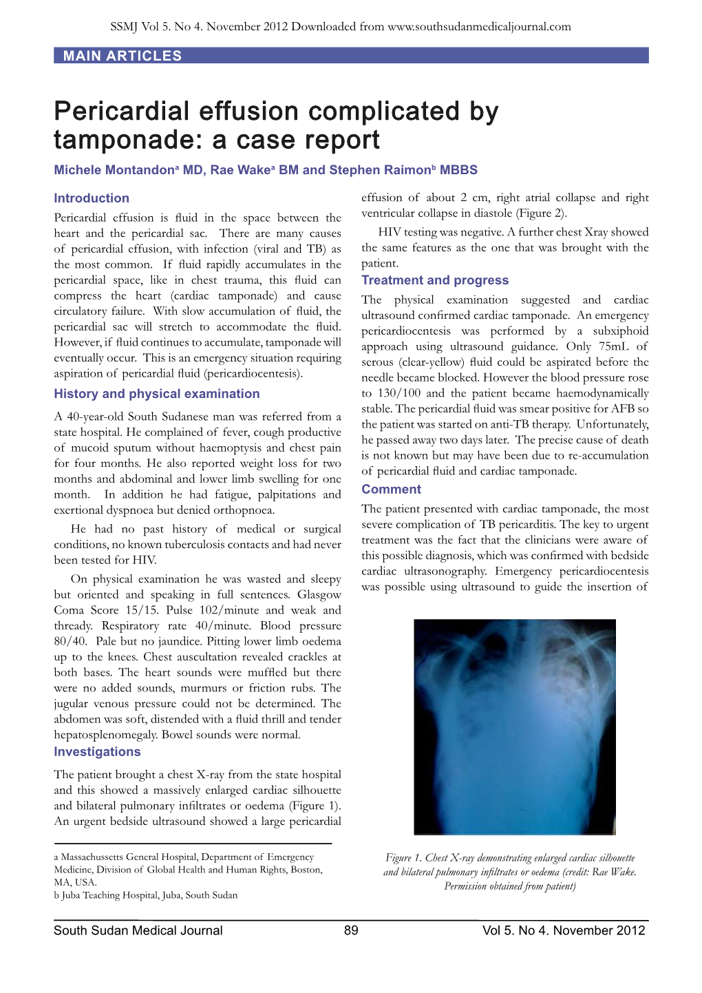 Pericardial Effusion Complicated by Tamponade: a Case Report Michele Montandona MD, Rae Wakea BM and Stephen Raimonb MBBS