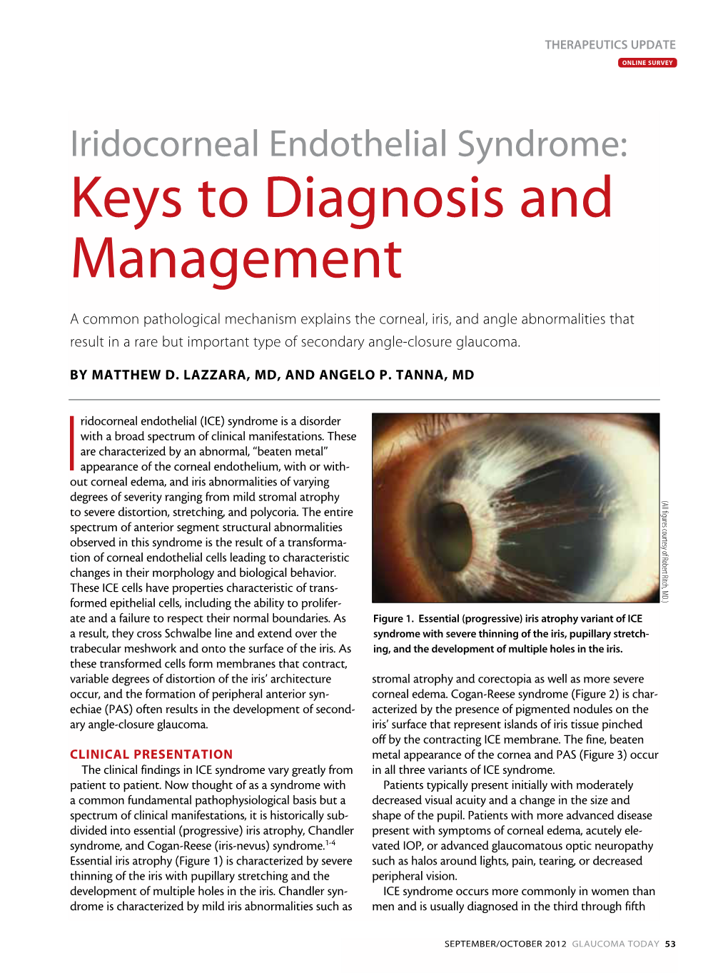 Iridocorneal Endothelial Syndrome: Keys to Diagnosis and Management