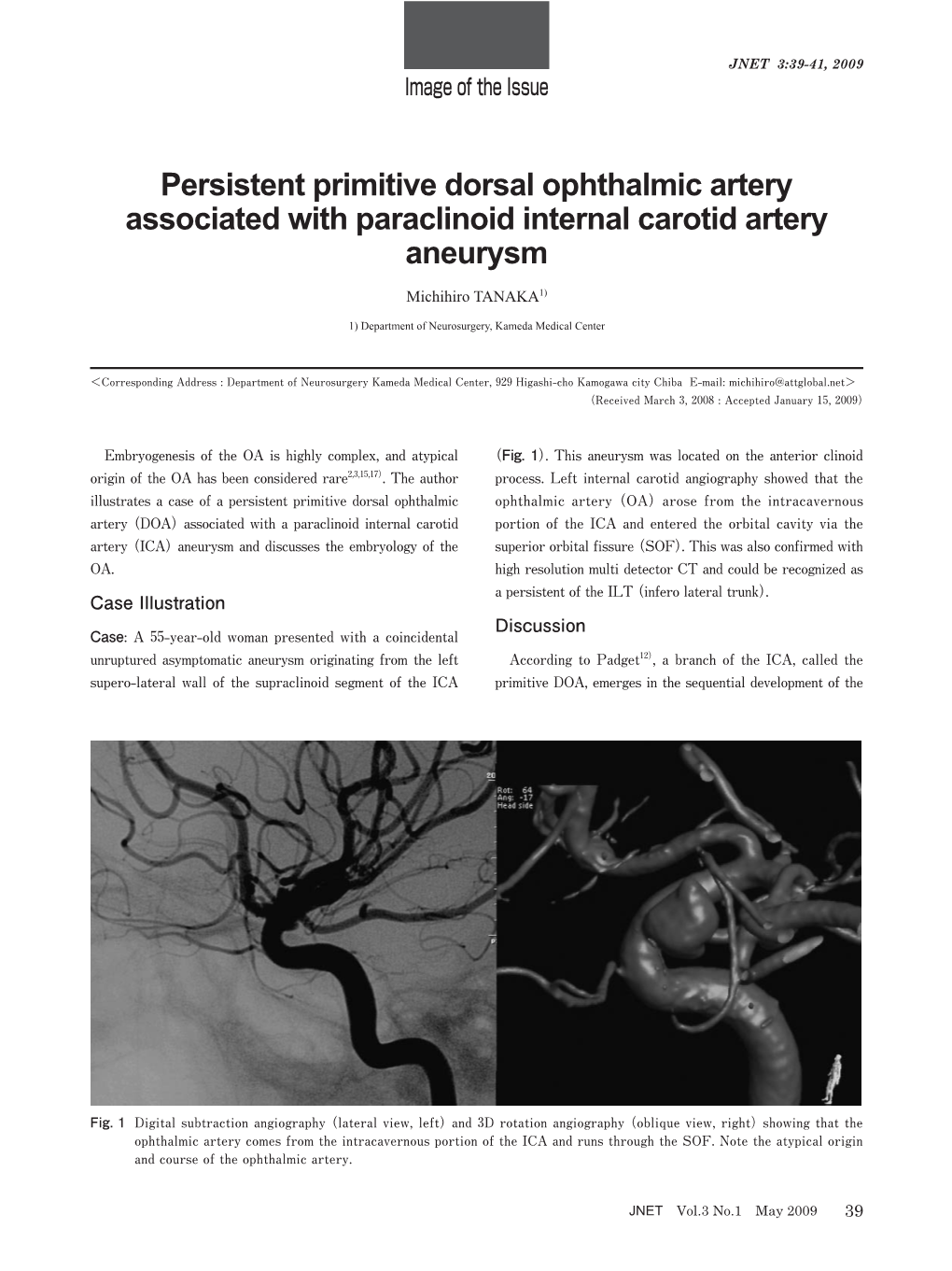 Persistent Primitive Dorsal Ophthalmic Artery Associated with Paraclinoid Internal Carotid Artery Aneurysm