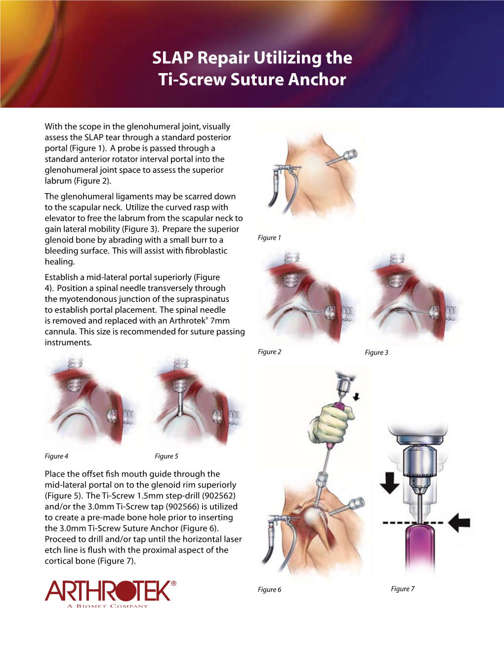 SLAP Repair Utilizing the 3.0Mm Ti-Screw Suture Anchor