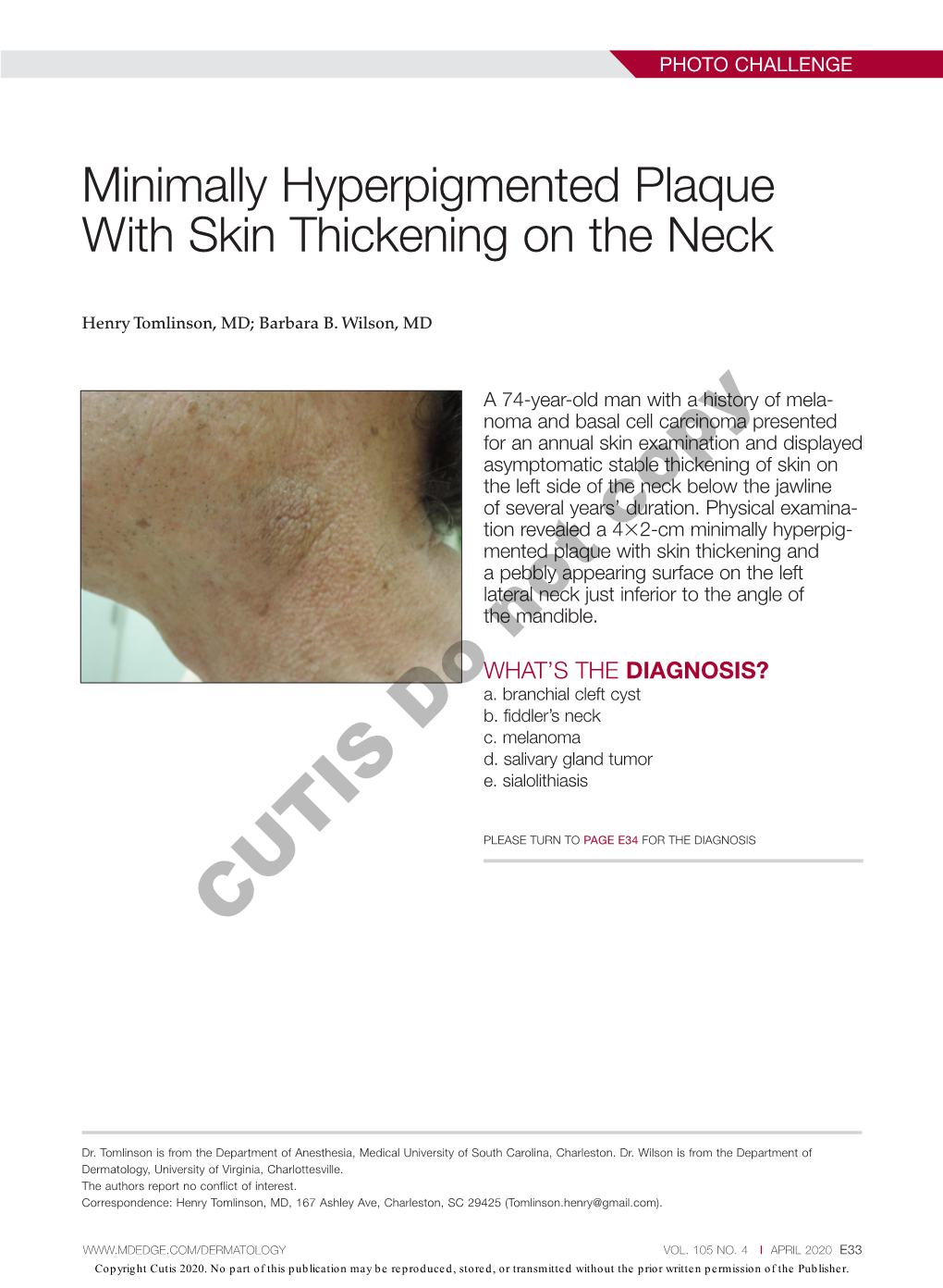 Minimally Hyperpigmented Plaque with Skin Thickening on the Neck