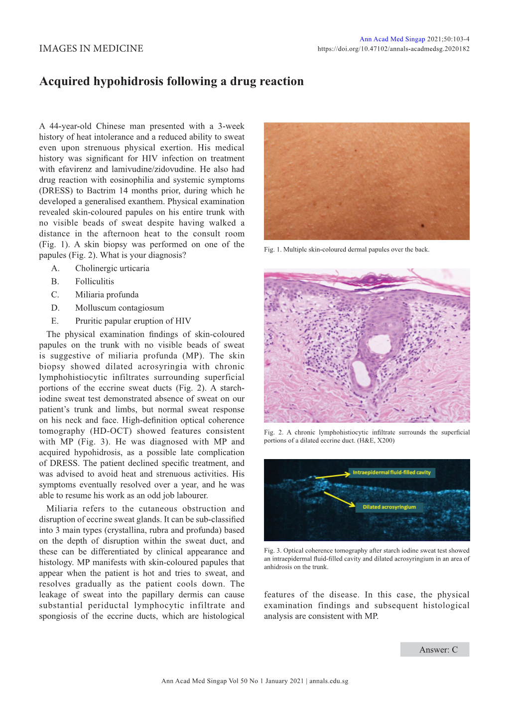 Acquired Hypohidrosis Following a Drug Reaction