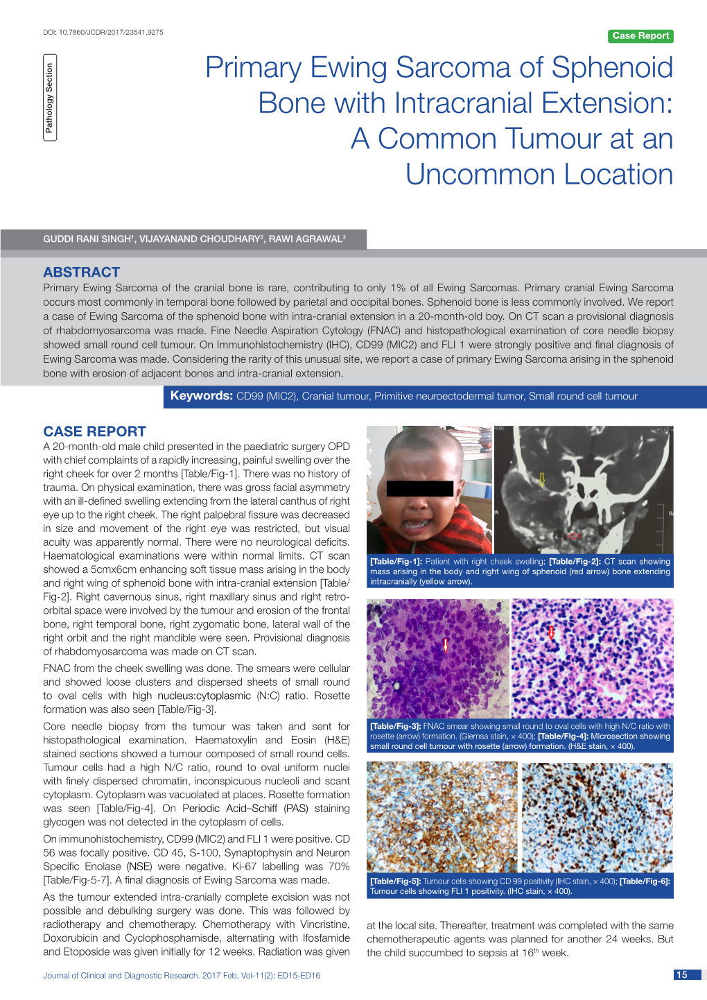 Primary Ewing Sarcoma of Sphenoid Bone with Intracranial Extension: Pathology Section a Common Tumour at an Uncommon Location