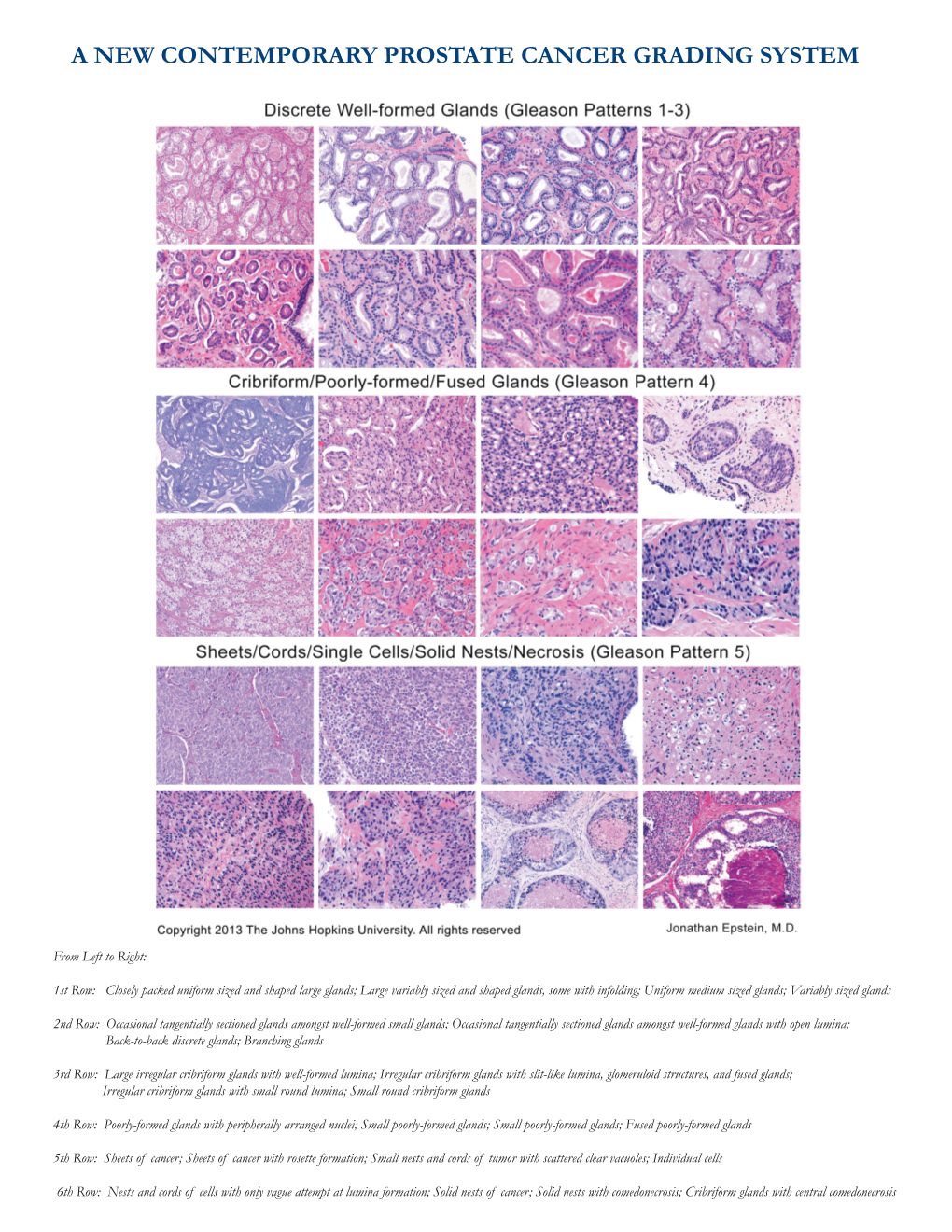 A New Contemporary Prostate Cancer Grading System