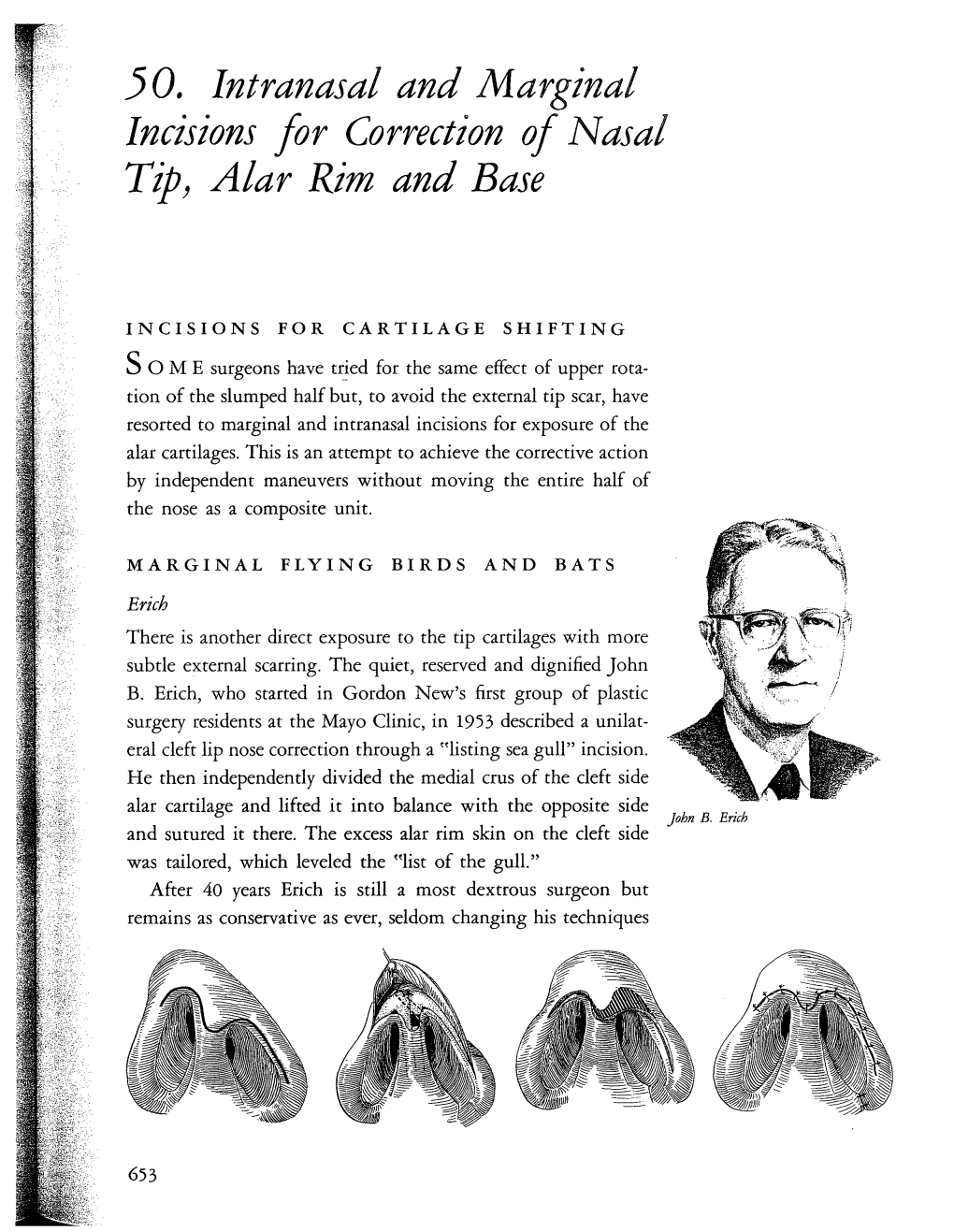 50. Intranasal and Marginal Incisions for Correction of Nasal Tip, Alar Rim