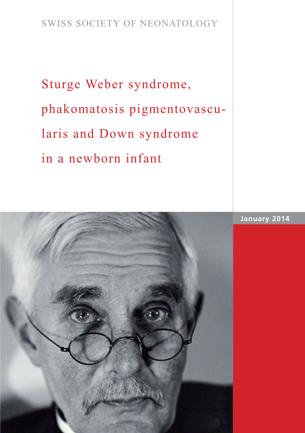 Sturge Weber Syndrome, Phakomatosis Pigmentovascu- Laris and Down Syndrome in a Newborn Infant