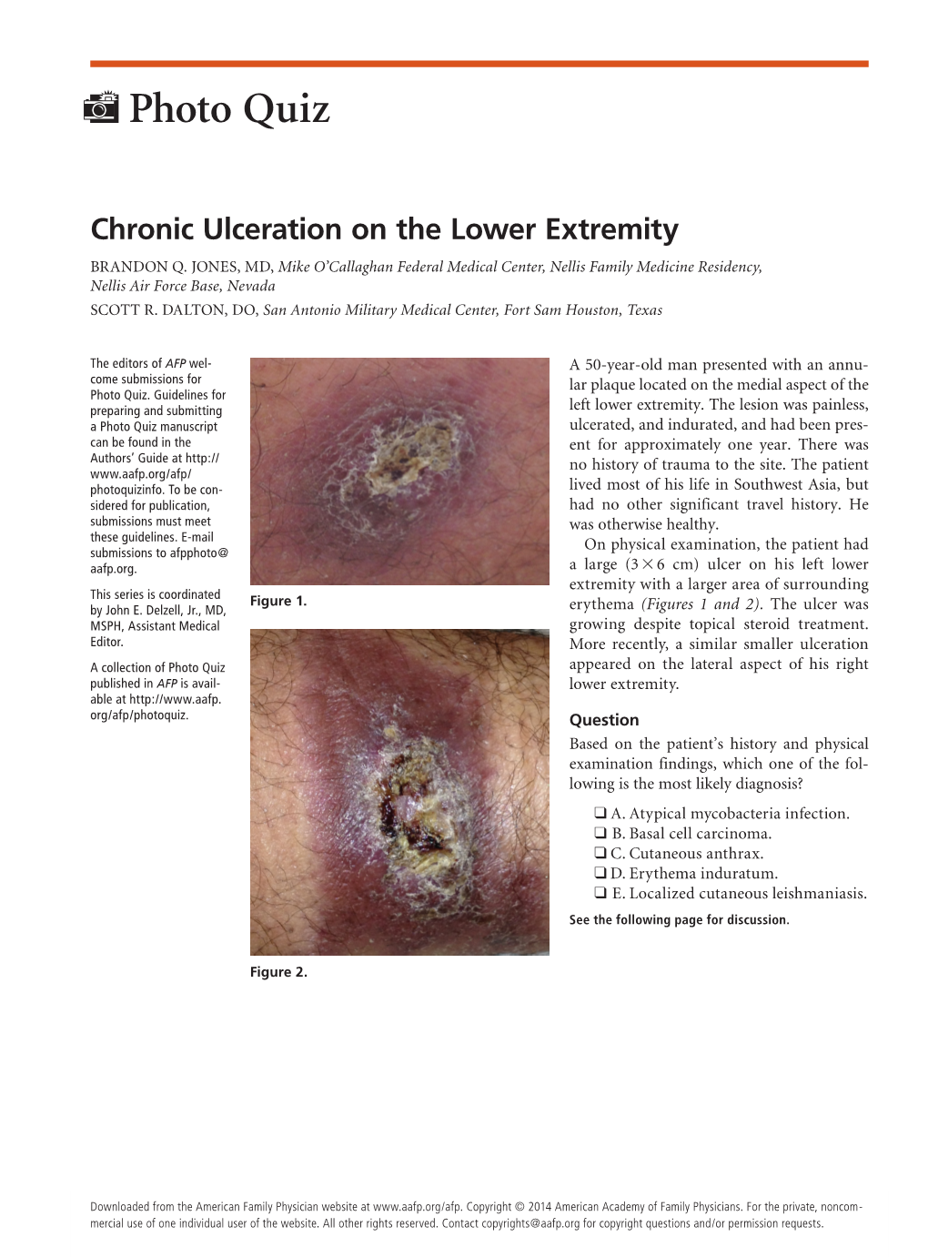 Chronic Ulceration on the Lower Extremity BRANDON Q