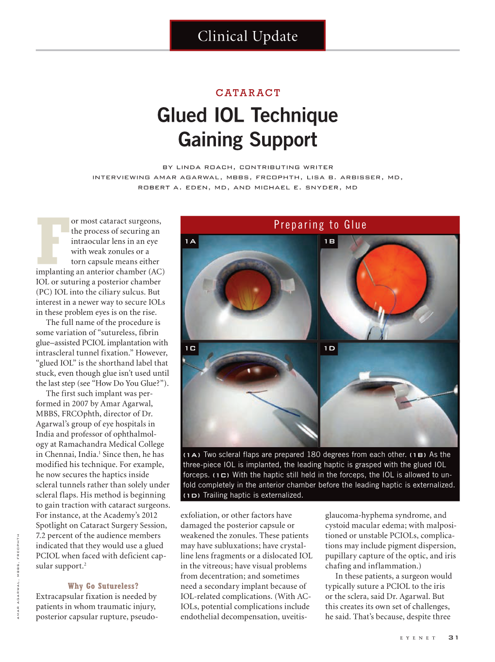 Glued IOL Technique Gaining Support