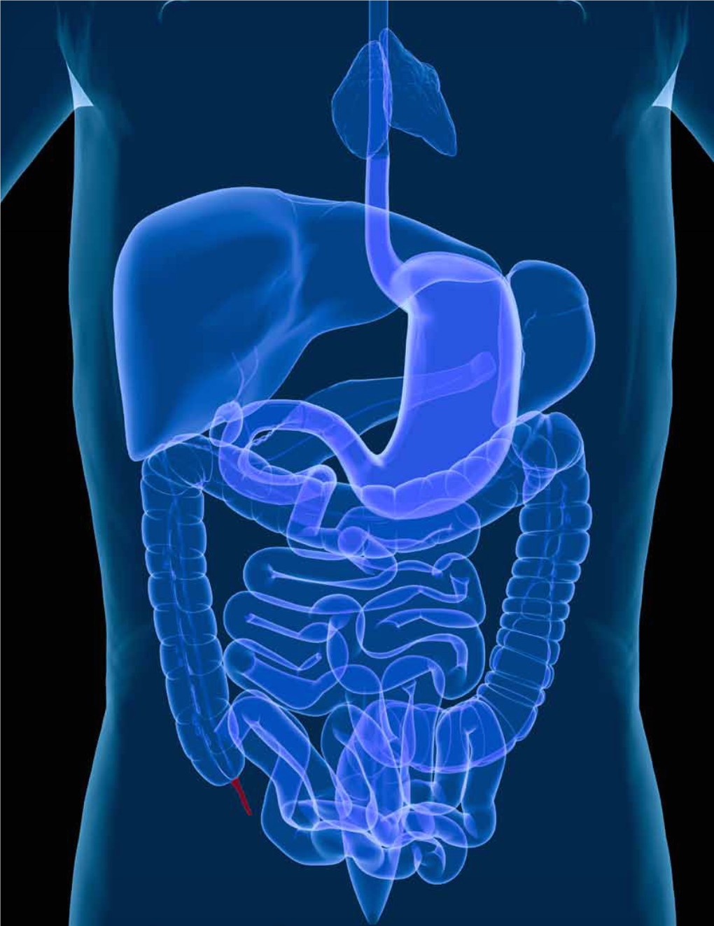 342: Adenocarcinoma of the Appendix