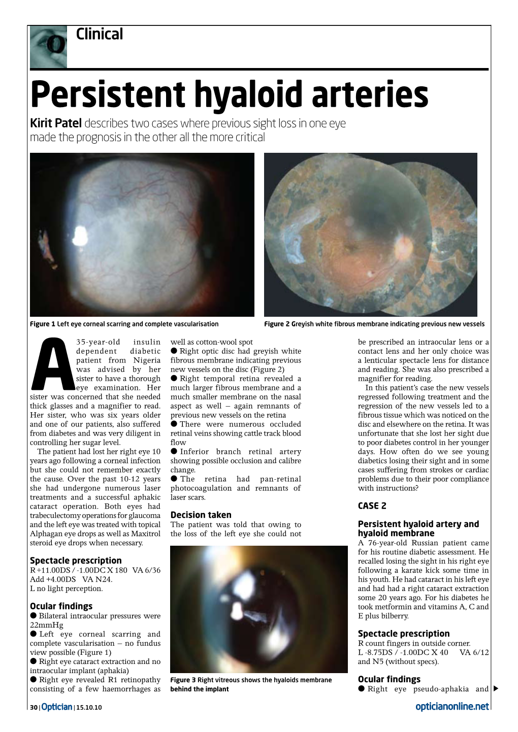 Persistent Hyaloid Arteries Kirit Patel Describes Two Cases Where Previous Sight Loss in One Eye Made the Prognosis in the Other All the More Critical