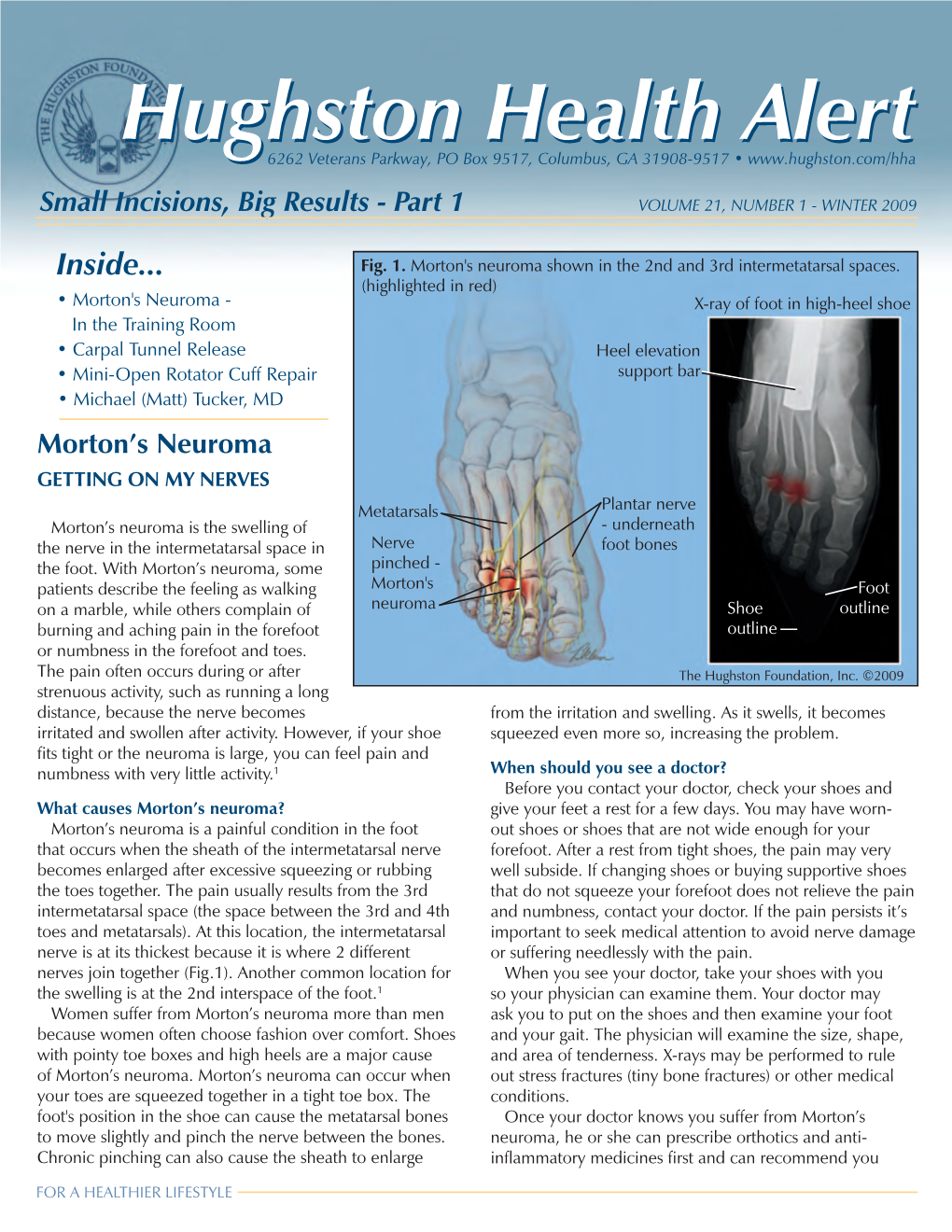 Morton's Neuroma Shown in the 2Nd and 3Rd Intermetatarsal Spaces