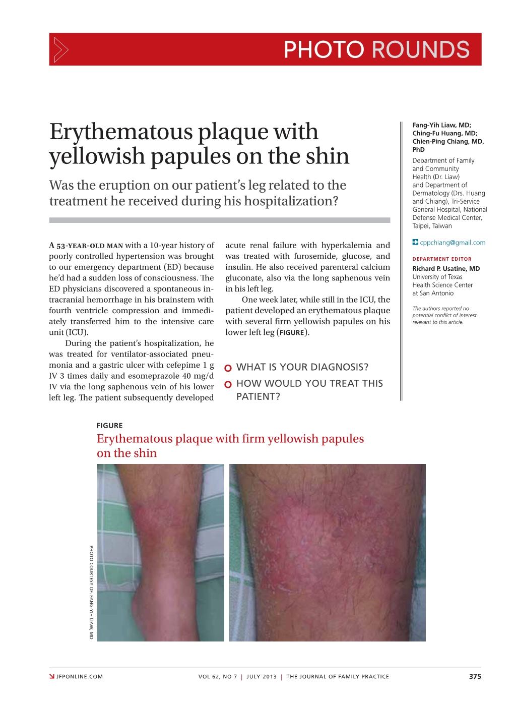 Erythematous Plaque with Yellowish Papules on the Shin