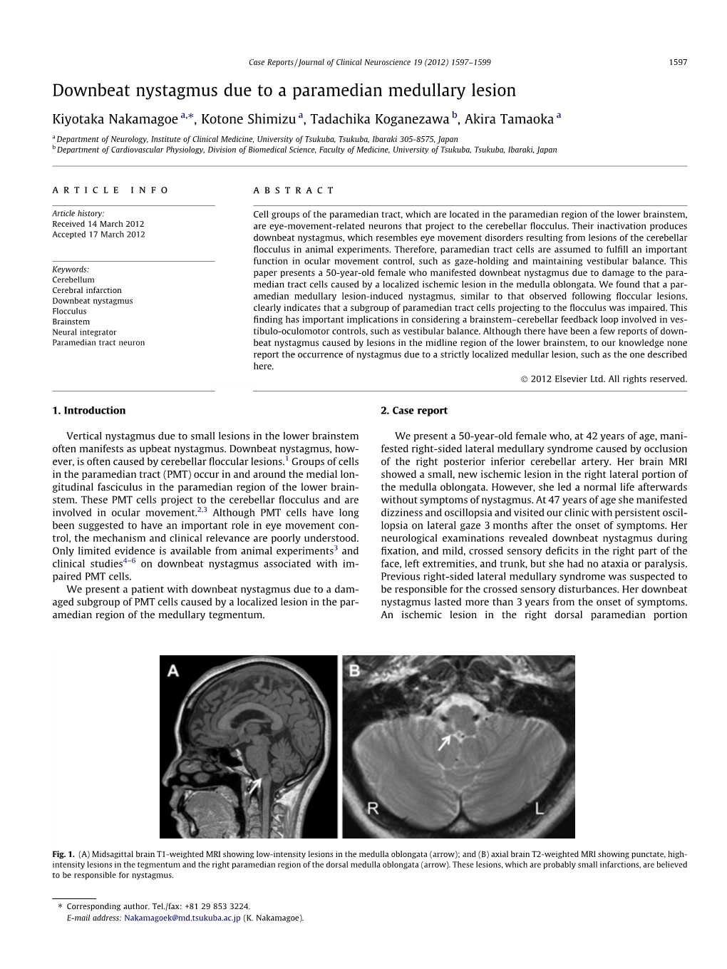 Downbeat Nystagmus Due to a Paramedian Medullary Lesion