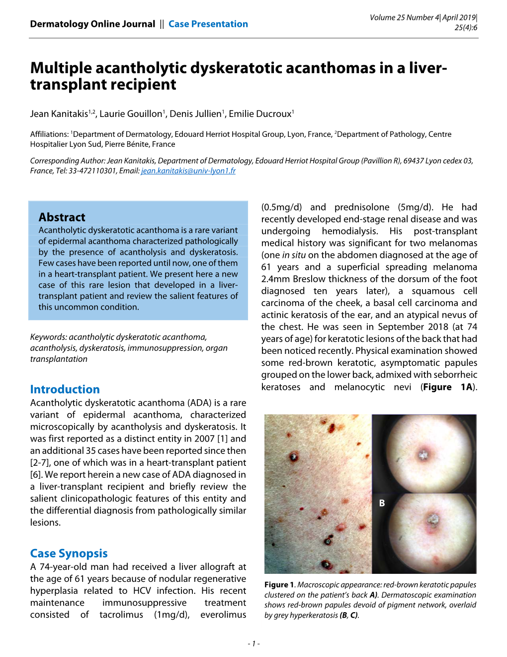 Multiple Acantholytic Dyskeratotic Acanthomas in a Liver- Transplant Recipient