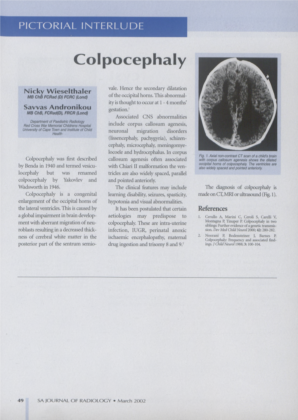 Colpocephaly