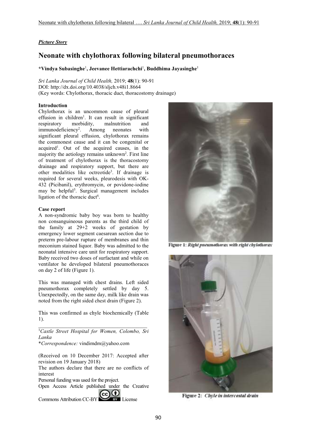 Neonate with Chylothorax Following Bilateral Pneumothoraces