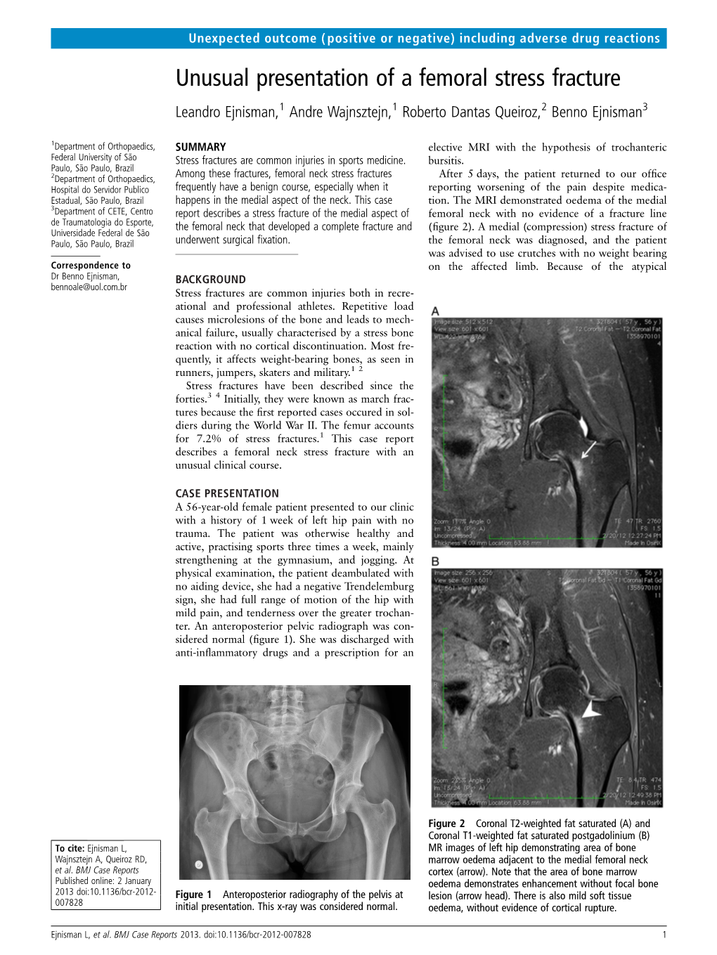 Unusual Presentation of a Femoral Stress Fracture Leandro Ejnisman,1 Andre Wajnsztejn,1 Roberto Dantas Queiroz,2 Benno Ejnisman3