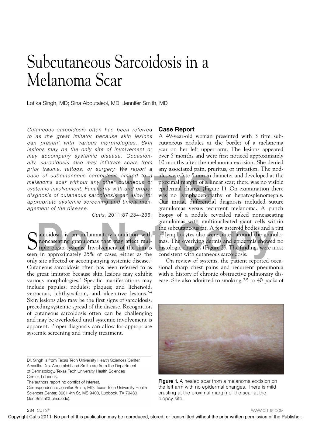 Subcutaneous Sarcoidosis in a Melanoma Scar