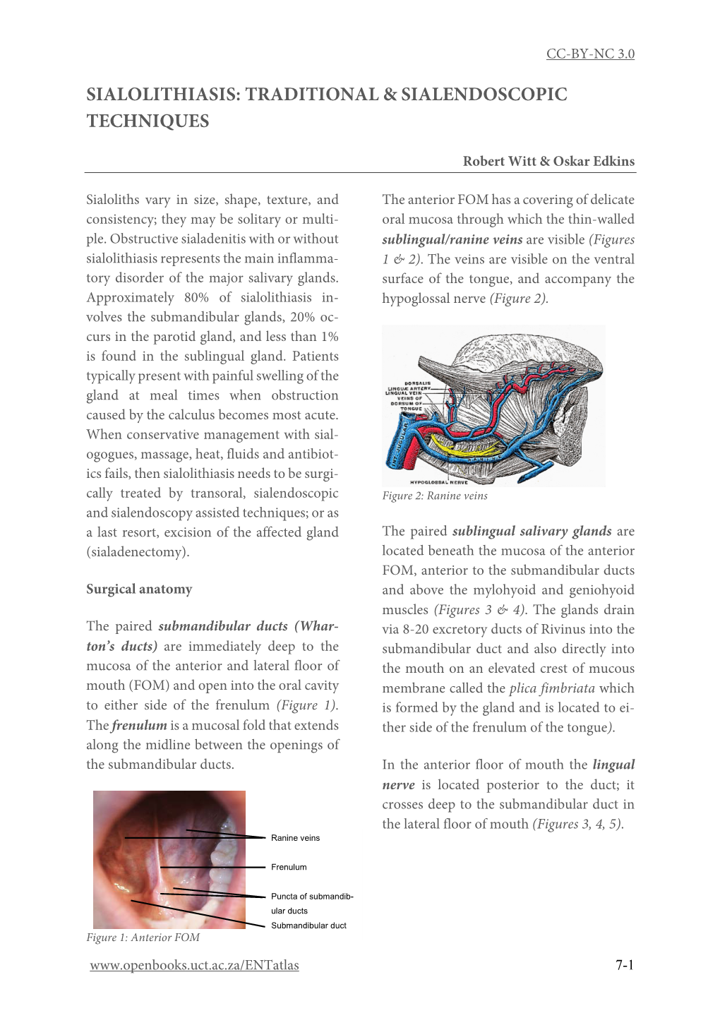 Sialolithiasis: Traditional and Sialendoscopic Techniques