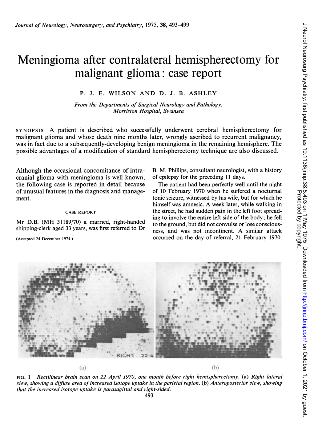 Meningioma After Contralateral Hemispherectomy for Malignant Glioma: Case Report