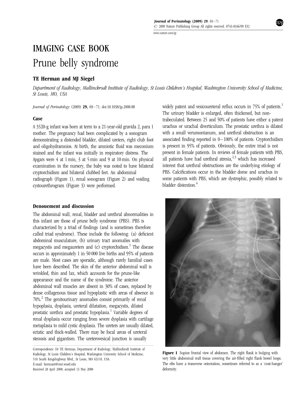 Prune Belly Syndrome