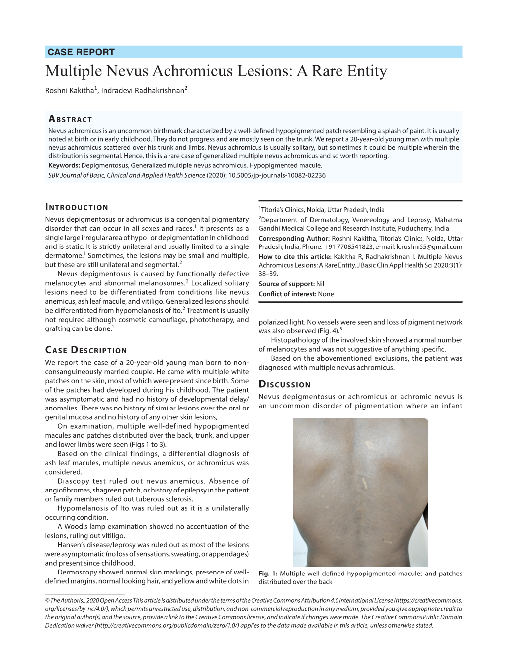 Multiple Nevus Achromicus Lesions: a Rare Entity Roshni Kakitha1, Indradevi Radhakrishnan2