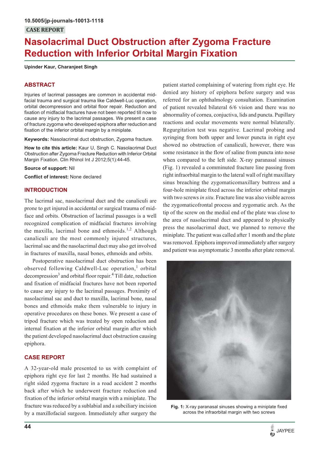 Nasolacrimal Duct Obstruction After Zygoma Fracture Reduction with Inferior Orbital Margin Fixation