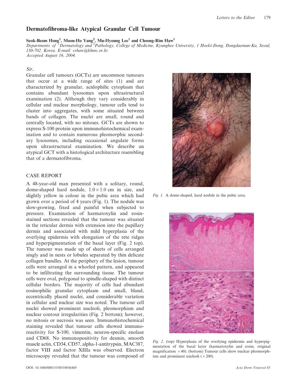 Dermatofibroma-Like Atypical Granular Cell Tumour