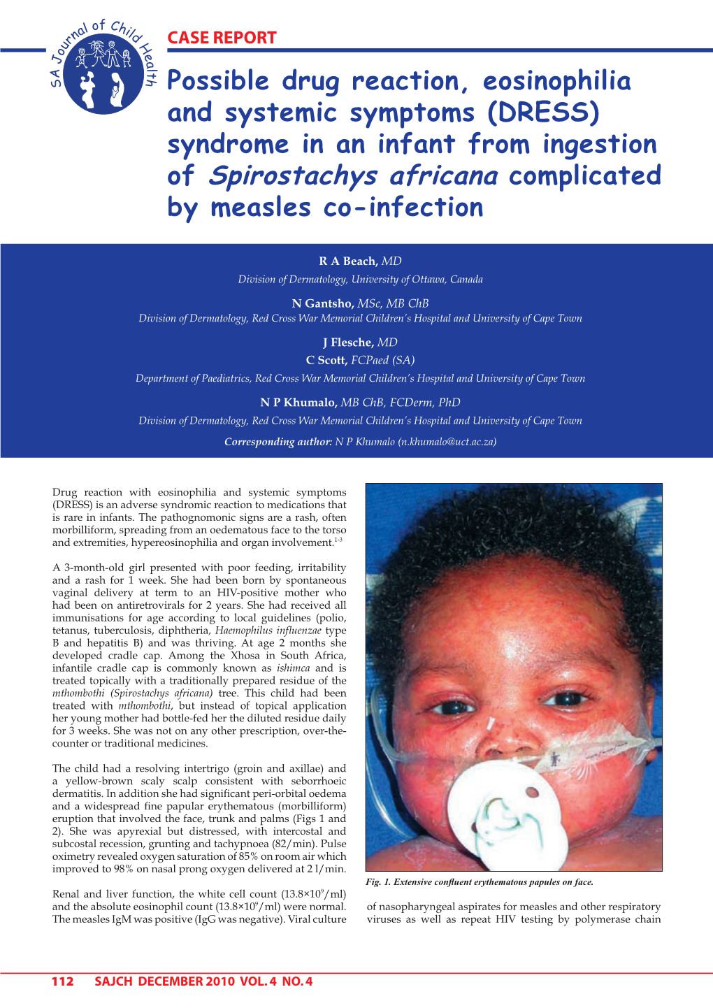 Of Spirostachys Africana Complicated by Measles Co-Infection