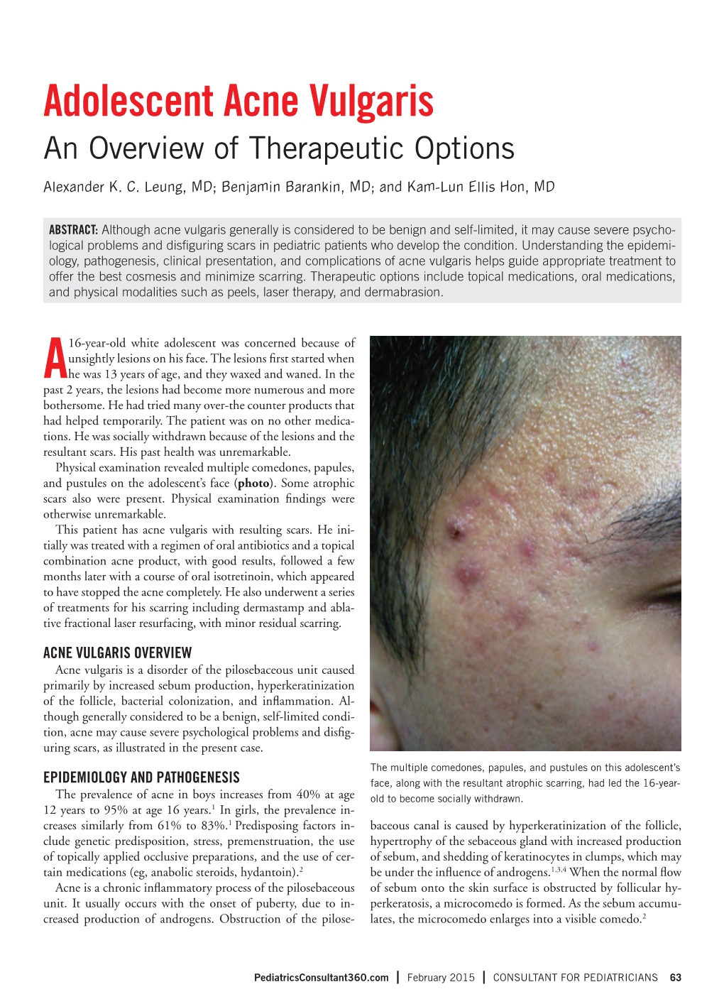 Adolescent Acne Vulgaris an Overview of Therapeutic Options