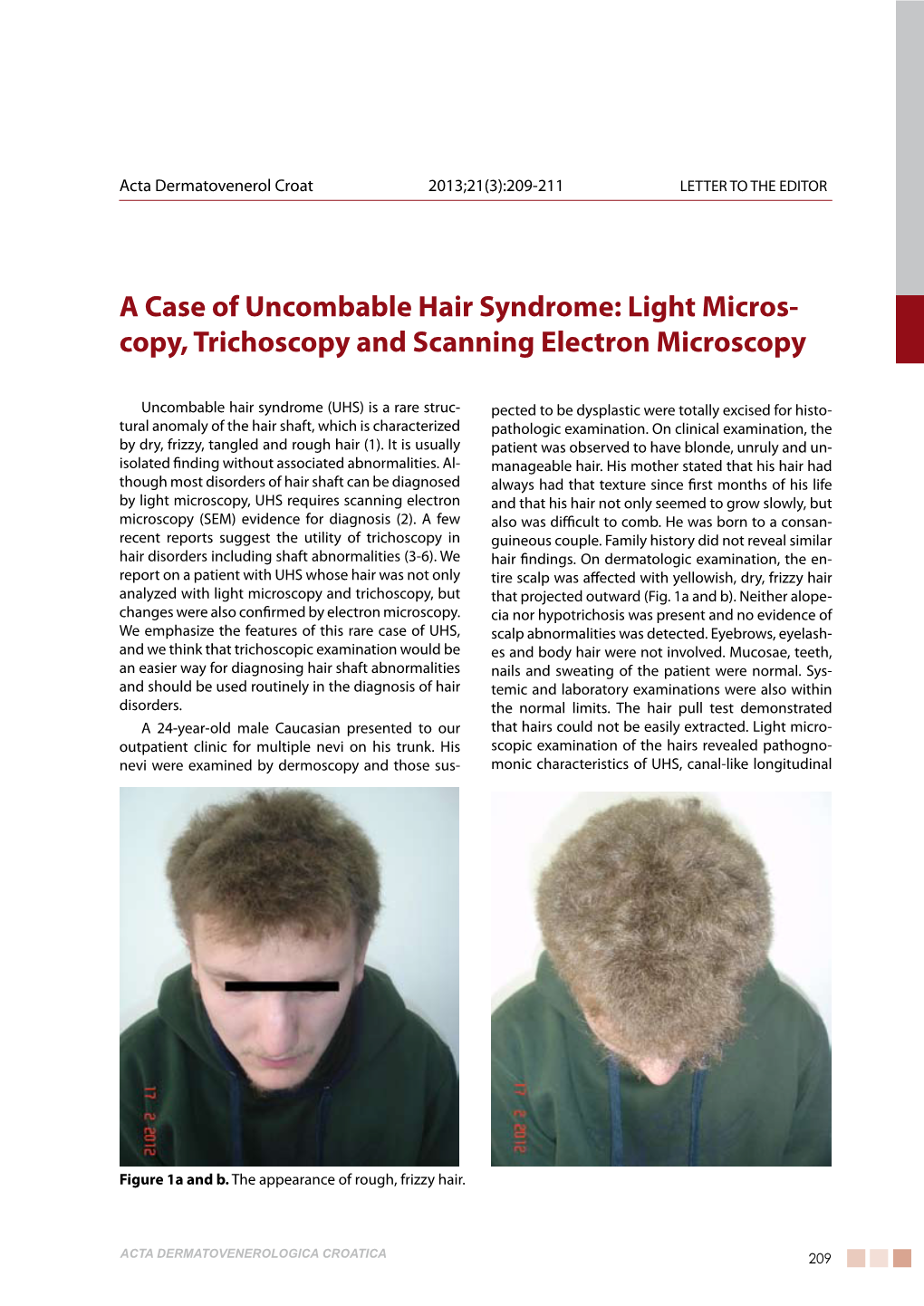 A Case of Uncombable Hair Syndrome: Light Micros- Copy, Trichoscopy and Scanning Electron Microscopy