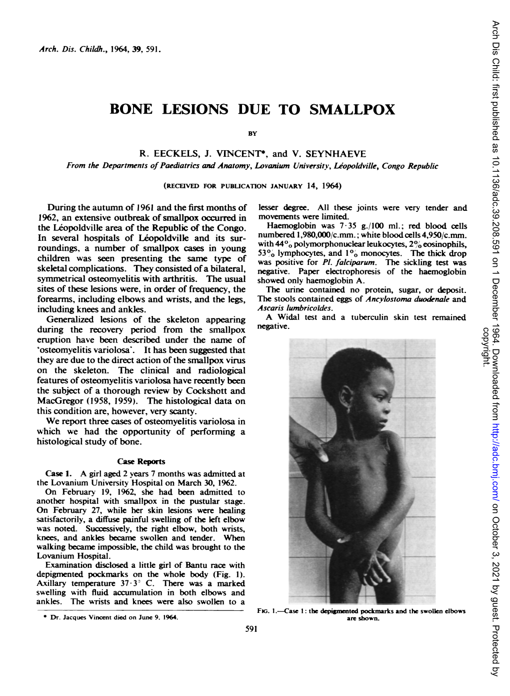 Bone Lesions Due to Smallpox