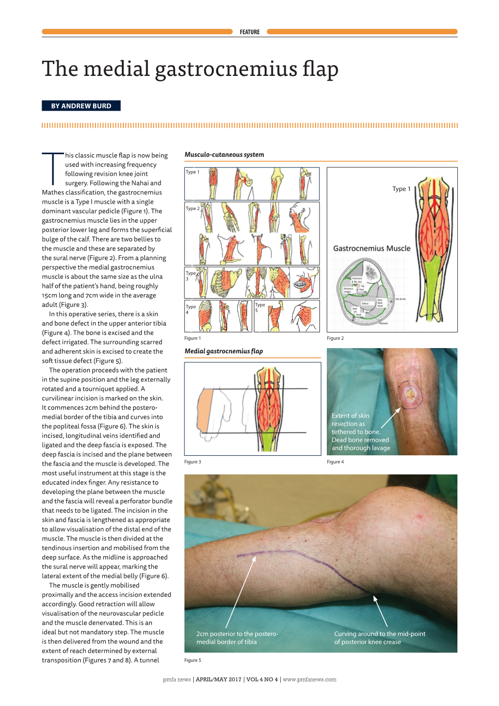 The Medial Gastrocnemius Flap