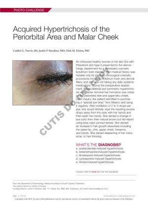 Acquired Hypertrichosis of the Periorbital Area and Malar Cheek