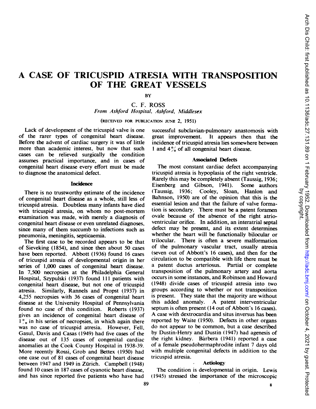 A Case of Tricuspid Atresia with Transposition of the Great Vessels by C